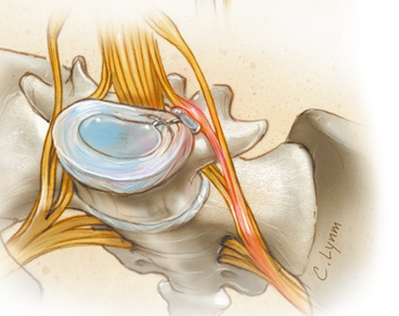 Herniated disc and pinched nerve